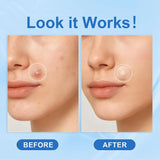 Amouy Acne Pimple Patch- 2 Sizes 432 Dots Thin & Thick Hydrocolloid Patches for Face with Witch Hazel